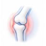 Arthritis