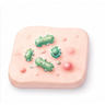 Bacterial Skin Infections