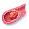 Blood Clots