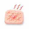Eczema
