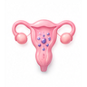 Endometriosis