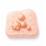 Genital Warts