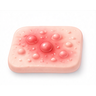Inflammatory Skin Conditions