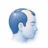 Male Pattern Hair Loss