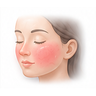 Rosacea