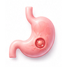 Stomach Ulcers